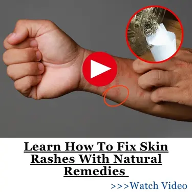 Learn How To Fix Skin Rashes With Natural Remedies BOR2