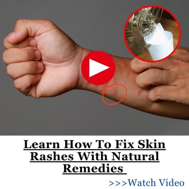 Learn How To Fix Skin Rashes With Natural Remedies BOR2