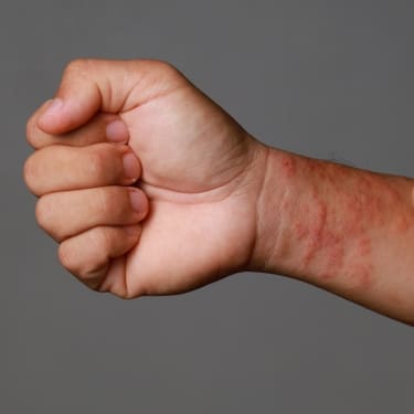 hand with severe rash